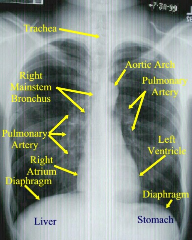 Chest X Ray